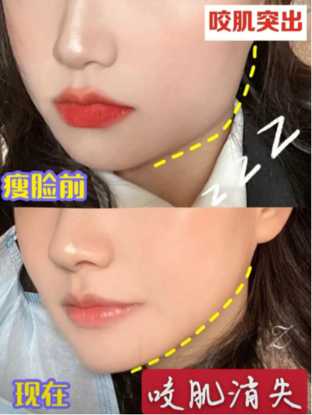 瘦脸