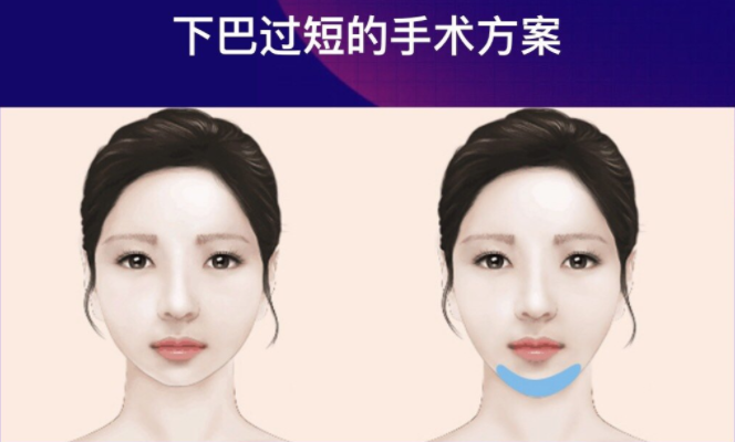垫下巴