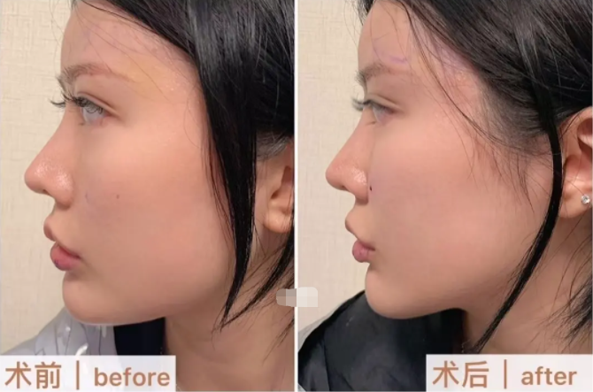 丰苹果肌