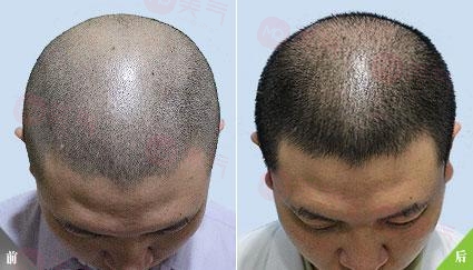 重庆毛发种植哪里有好的专业机构吗？