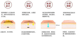 激光去红血丝
