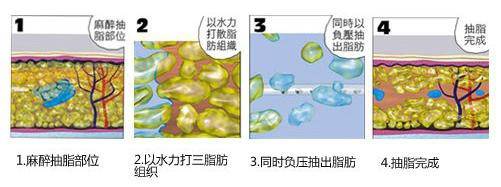 水动力吸脂减肥2.jpg