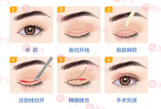 上海九院双眼皮哪个医生比较好？