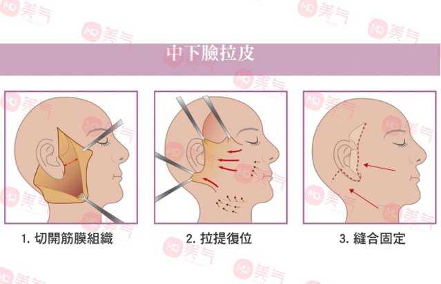 上海九院拉皮手术哪个医生做的好？