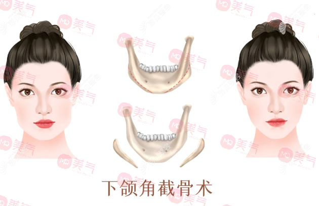 上海九院磨骨有名的医生推荐