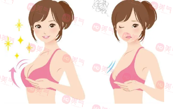 重庆丰胸得多钱？2万的曼托假体隆胸要不要做